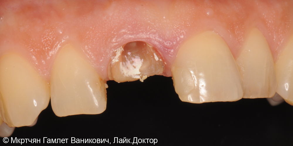 Удаление переднего зуба, установка импланта и временной коронки - фото №1