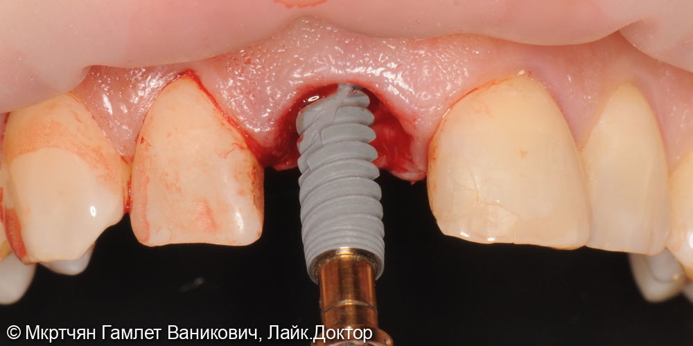 Удаление переднего зуба, установка импланта и временной коронки - фото №2