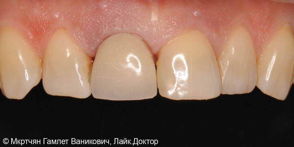 Удаление переднего зуба, установка импланта и временной коронки - фото №4