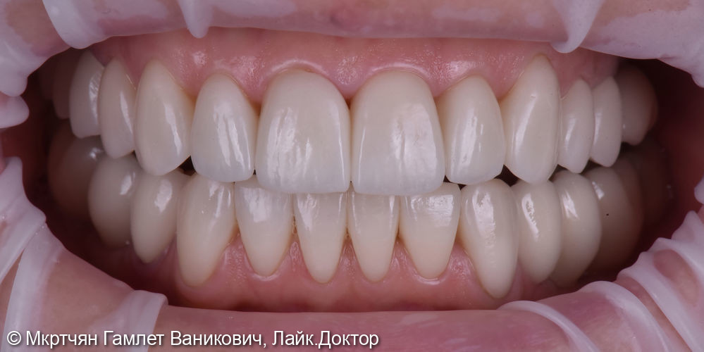 Комплексное функциональное и эстетическое восстановление зубных рядов с помощью имплантов и виниров - фото №3