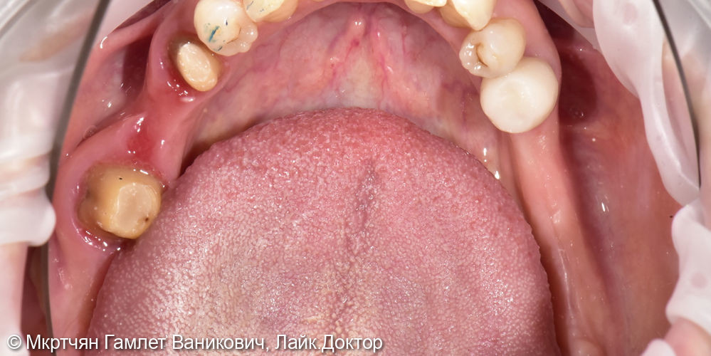 Восстановление отсутствующих зубов на нижней челюсти с помощью имплантов - фото №1