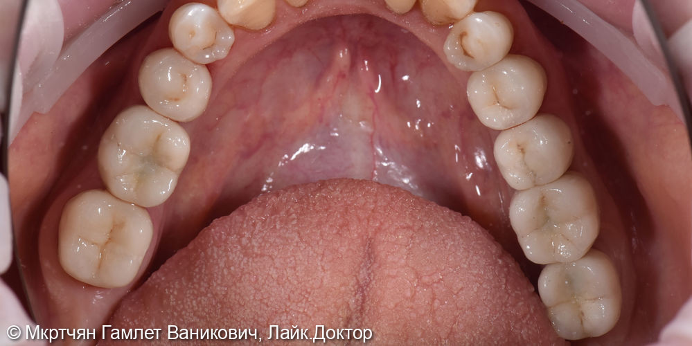 Восстановление отсутствующих зубов на нижней челюсти с помощью имплантов - фото №2