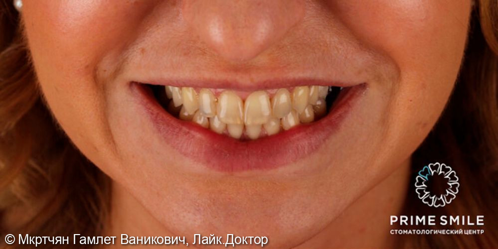 Эстетическое восстановление зубов с помощью керамических виниров E-max - фото №1