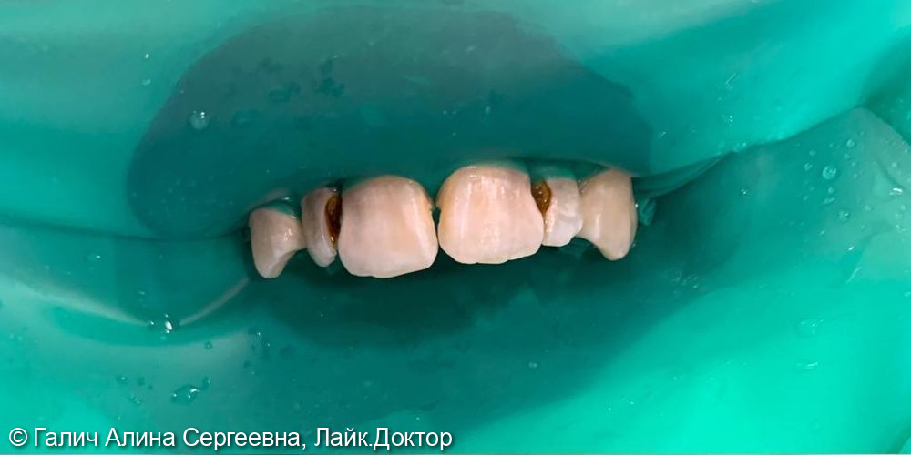 Лечение кариеса зуб 11,12,21,22 - фото №1