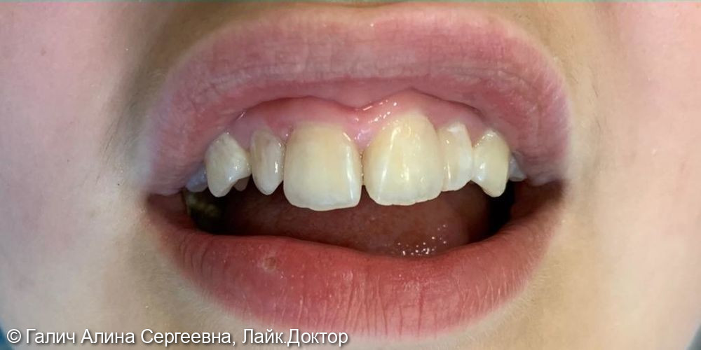 Лечение кариеса зуб 11,12,21,22 - фото №2