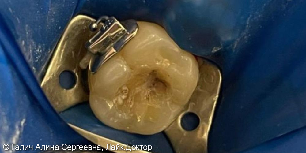 Лечение кариеса жевательного зуба 2.6 - фото №1