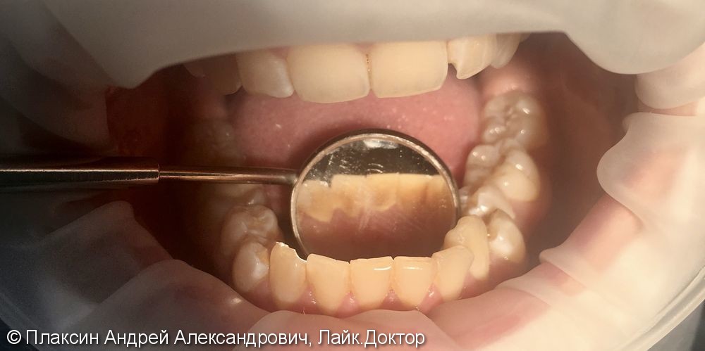 Профессиональная гигиена зубов - фото №1