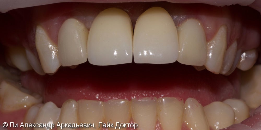 Имплантация зубов во фронтальном отделе - фото №2