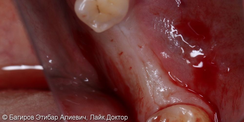 Установка имплантатов с наращиванием десны на нижней челюсти в области жевательной группы зубов, до и после - фото №1