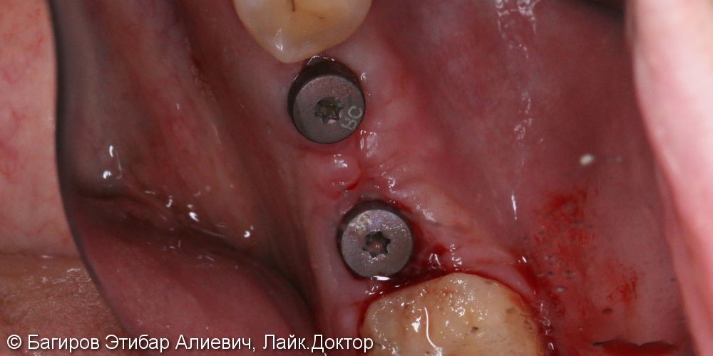 Установка имплантатов с наращиванием десны на нижней челюсти в области жевательной группы зубов, до и после - фото №3
