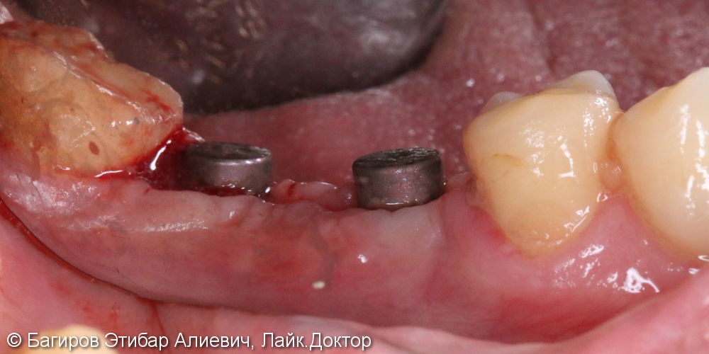 Установка имплантатов с наращиванием десны на нижней челюсти в области жевательной группы зубов, до и после - фото №4