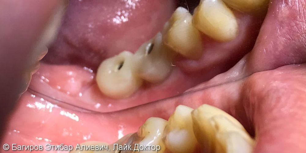 Установка имплантатов с наращиванием десны на нижней челюсти в области жевательной группы зубов, до и после - фото №6