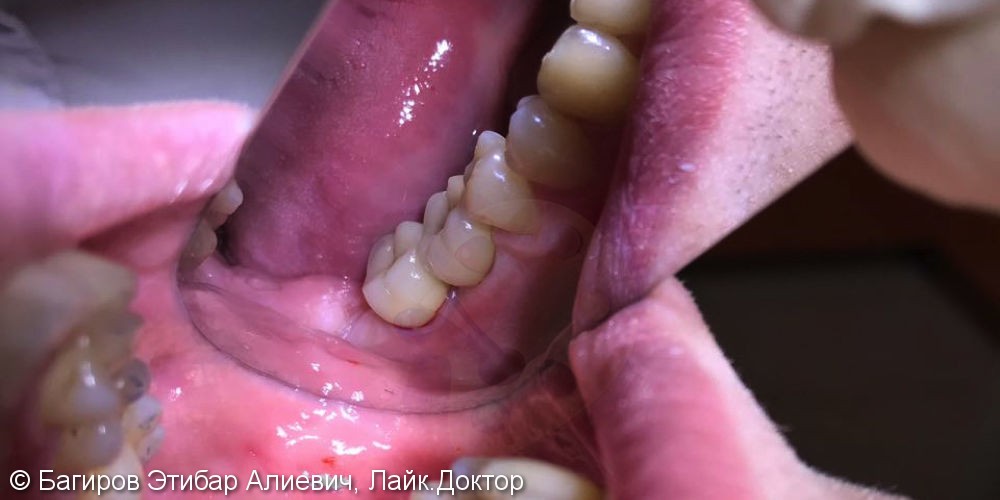 Установка имплантатов с наращиванием десны на нижней челюсти в области жевательной группы зубов, до и после - фото №8