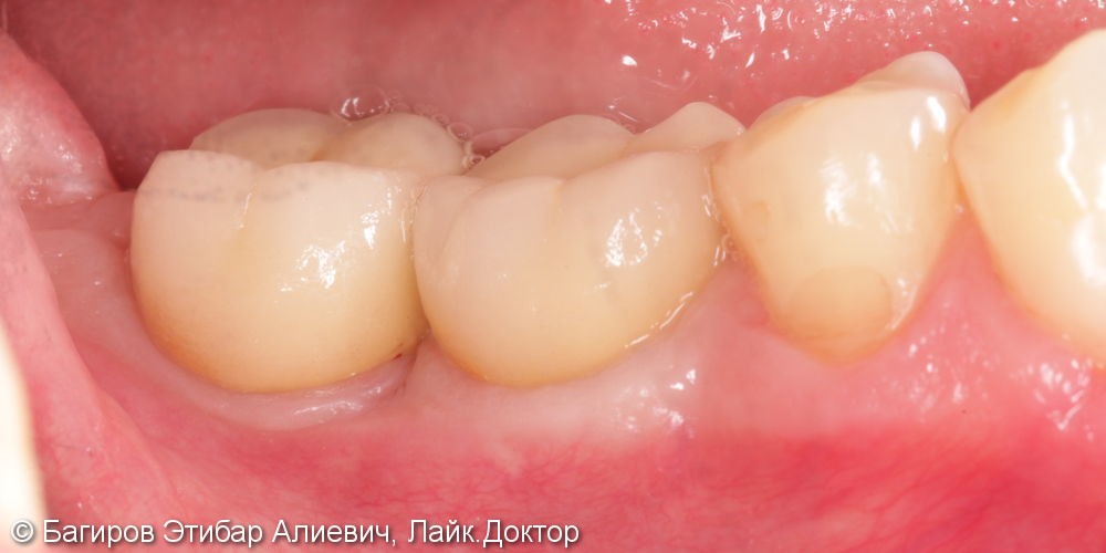 Установка имплантатов с наращиванием десны на нижней челюсти в области жевательной группы зубов, до и после - фото №9