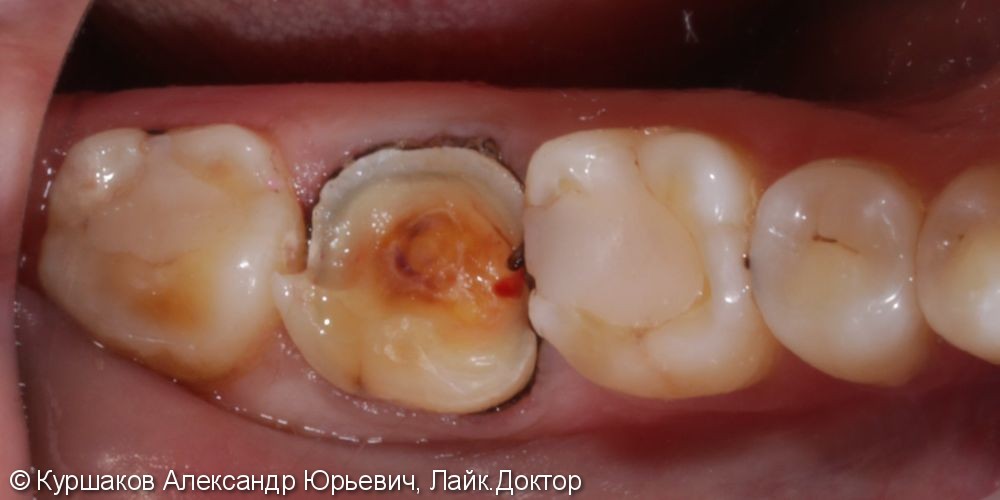 Восстановление зуба накладкой E-max - фото №1