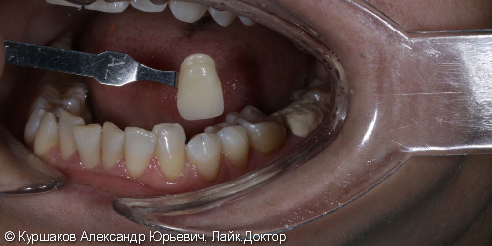 Восстановление зуба накладкой E-max - фото №3