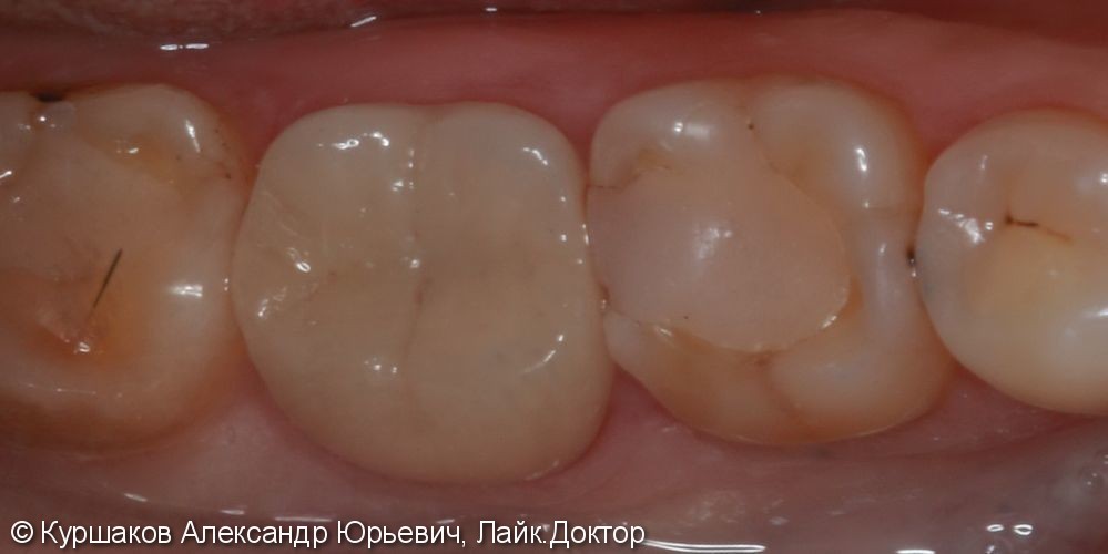 Восстановление зуба накладкой E-max - фото №6