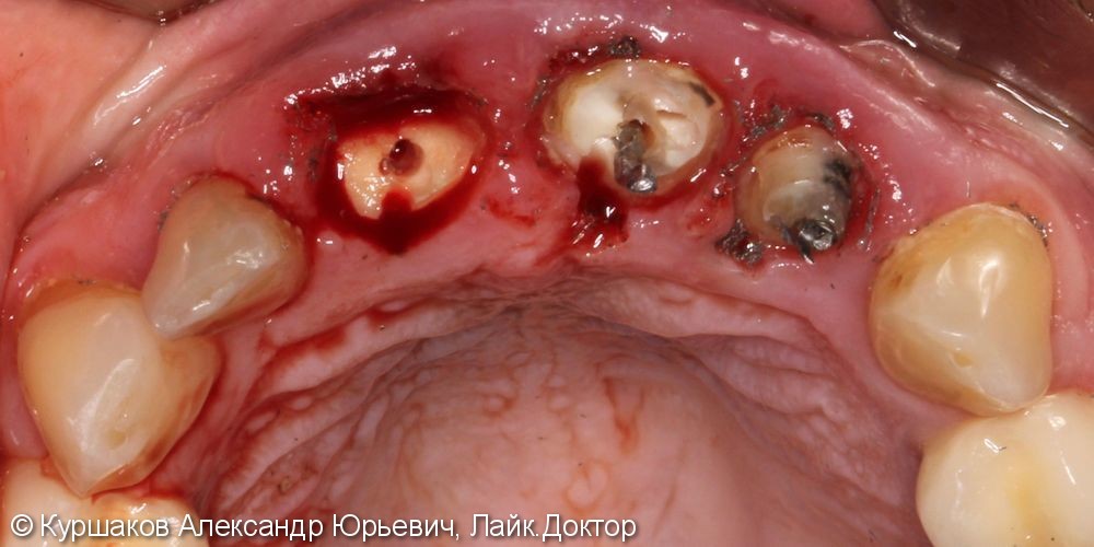 Восстановление красивой улыбки. Установка керамических коронок с опорой на импланты - фото №3