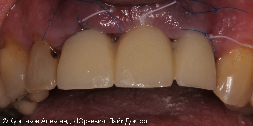 Восстановление красивой улыбки. Установка керамических коронок с опорой на импланты - фото №6