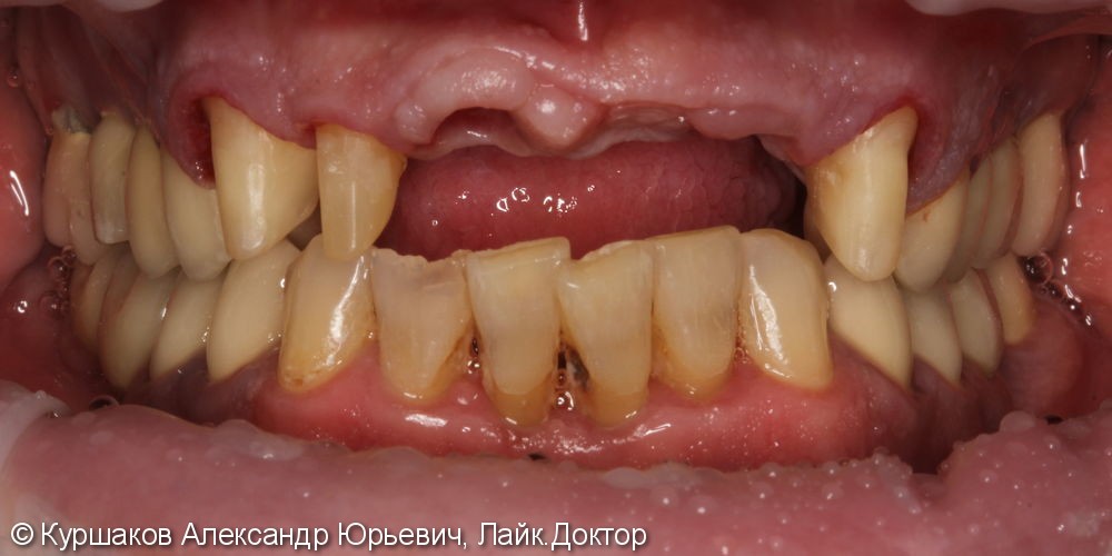 Восстановление красивой улыбки. Установка керамических коронок с опорой на импланты - фото №7