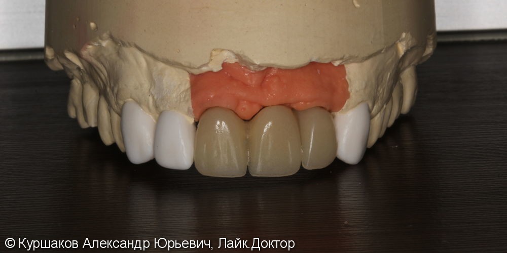 Восстановление красивой улыбки. Установка керамических коронок с опорой на импланты - фото №8