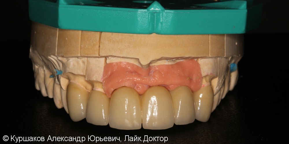 Восстановление красивой улыбки. Установка керамических коронок с опорой на импланты - фото №10