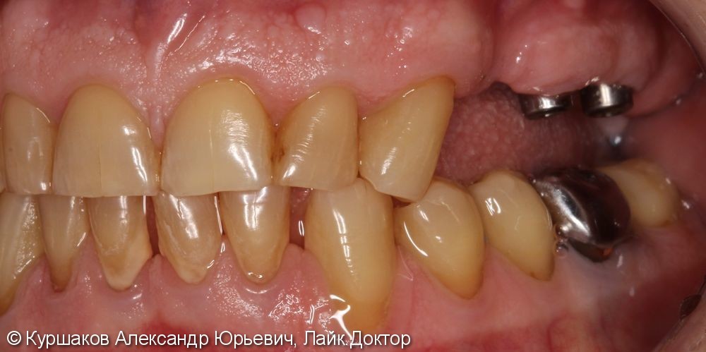 Имплантация трех зубов с установкой коронок на импланты - фото №1