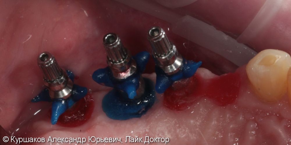 Имплантация трех зубов с установкой коронок на импланты - фото №3
