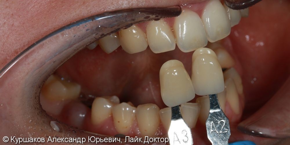 Реставрация зуба с установкой керамической коронки - фото №2