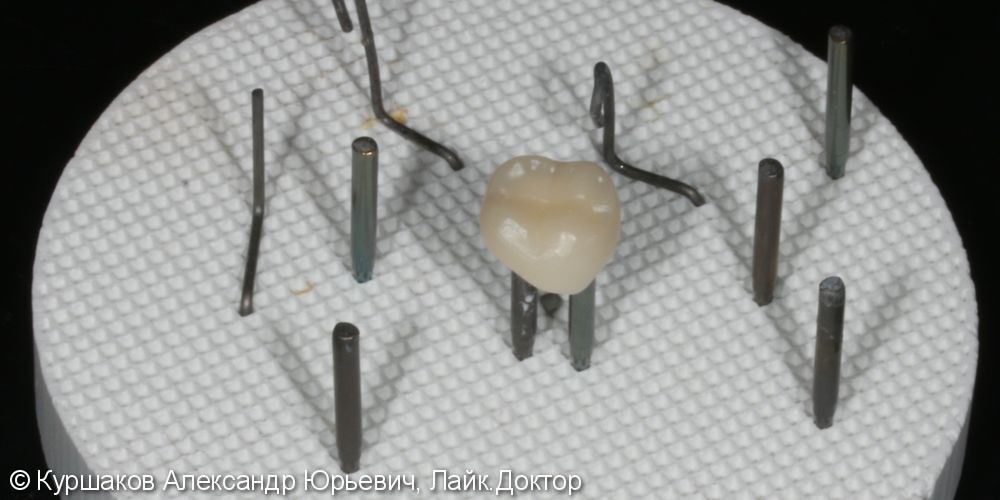 Реставрация зуба с установкой керамической коронки - фото №4