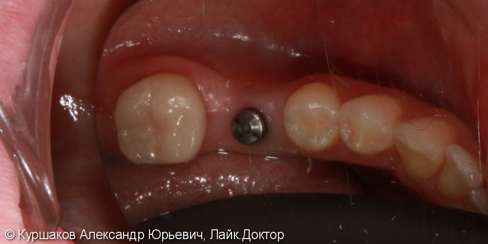Реставрация зуба с установкой керамической коронки - фото №5