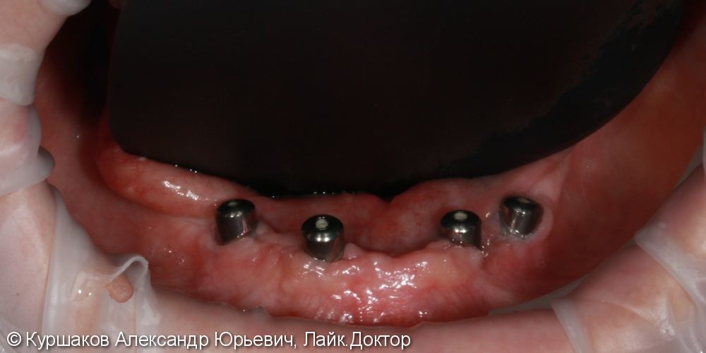 Протезирование нижней челюсти с опорой на импланты - фото №3