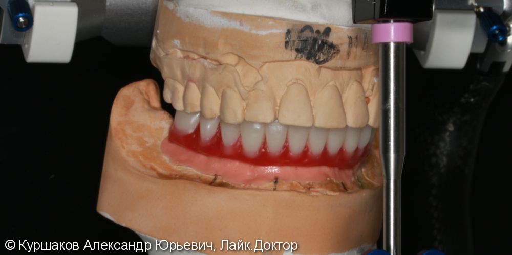 Протезирование нижней челюсти с опорой на импланты - фото №5