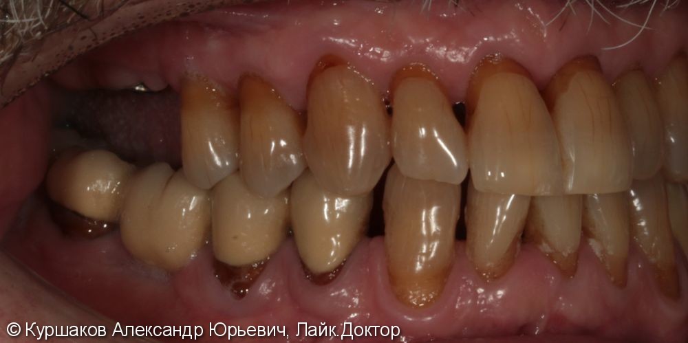 Восстановление зубов с использование технологии синус-лифтинга - фото №2
