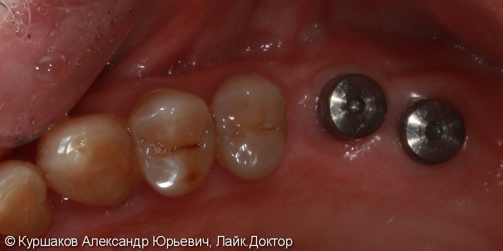 Восстановление зубов с использование технологии синус-лифтинга - фото №3