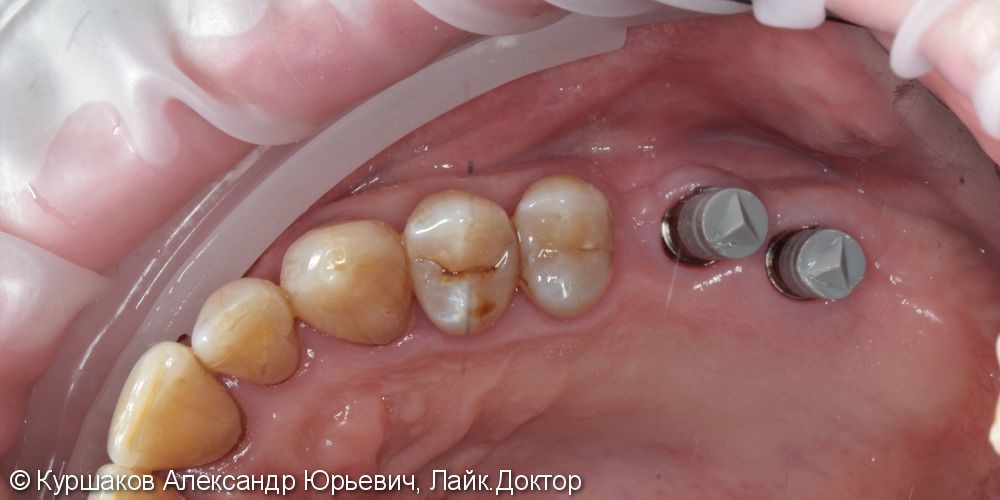 Восстановление зубов с использование технологии синус-лифтинга - фото №5