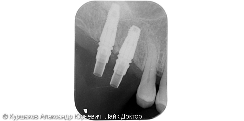 Восстановление зубов с использование технологии синус-лифтинга - фото №6