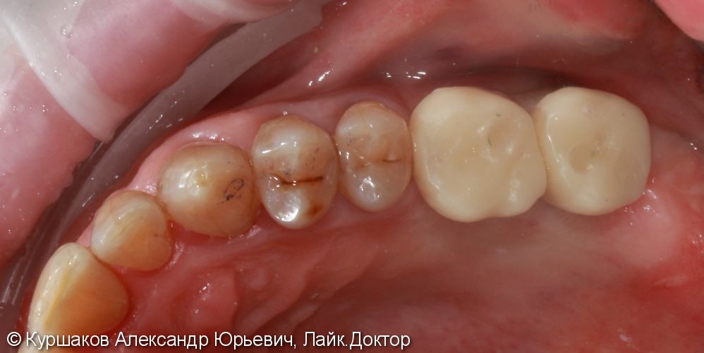 Восстановление зубов с использование технологии синус-лифтинга - фото №7