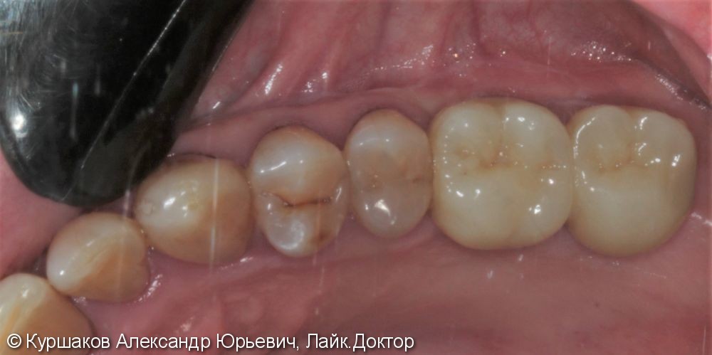Восстановление зубов с использование технологии синус-лифтинга - фото №12