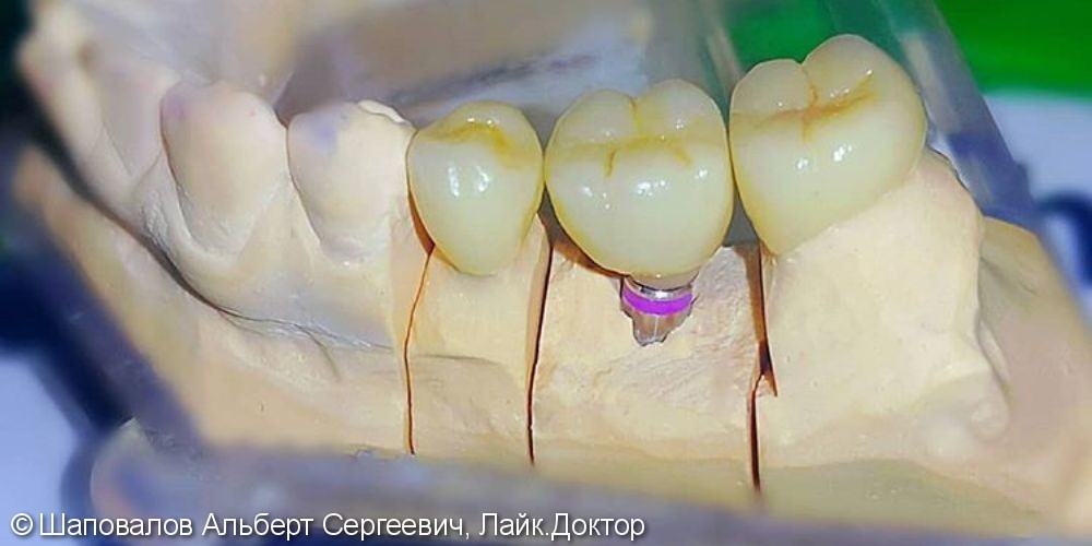 Имплантация и протезирование 3х жевательных зубов - фото №1