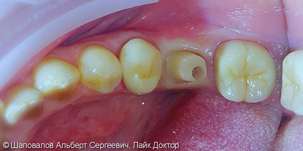 Имплантация и протезирование 3х жевательных зубов - фото №2