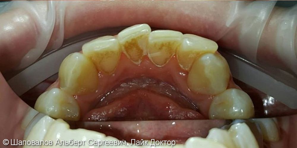 Профессиональная гигиена зубов и консультация - фото №1