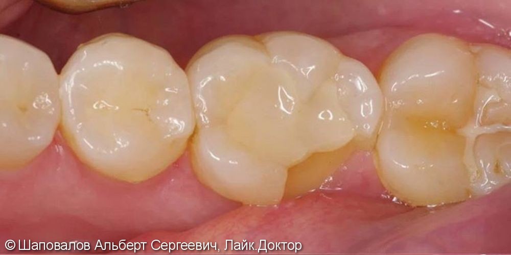 Лечение скола жевательного зуба керамической накладкой emax с перекрытием бугров - фото №1