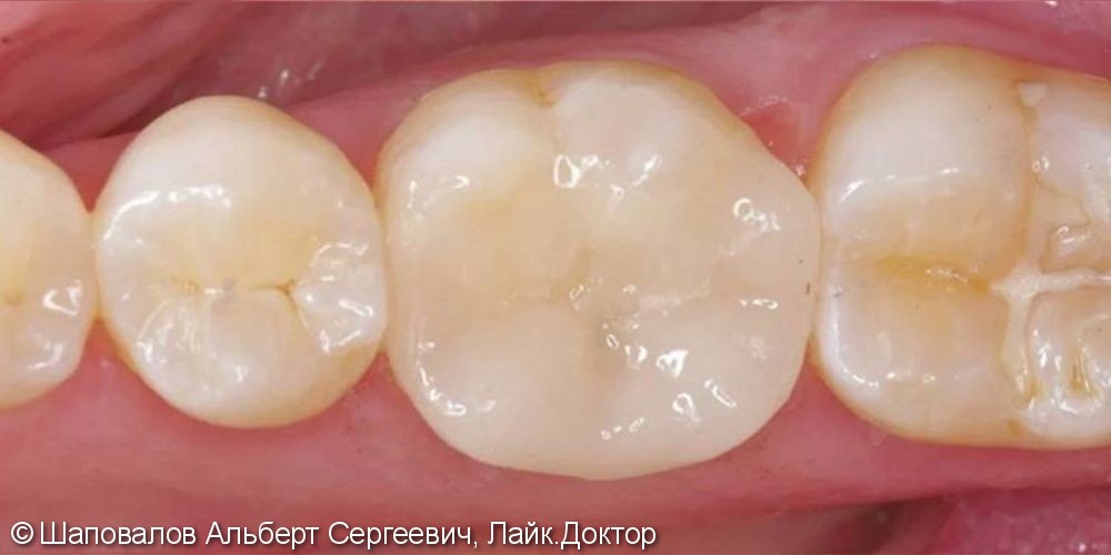 Лечение скола жевательного зуба керамической накладкой emax с перекрытием бугров - фото №2