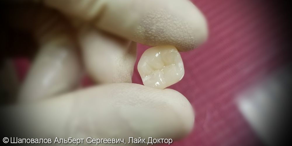 Восстановление разрушенного 3.6 зуба керамической накладкой - фото №1