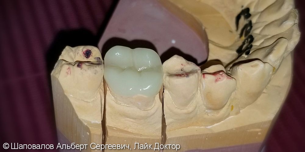 Восстановление разрушенного 3.6 зуба керамической накладкой - фото №4