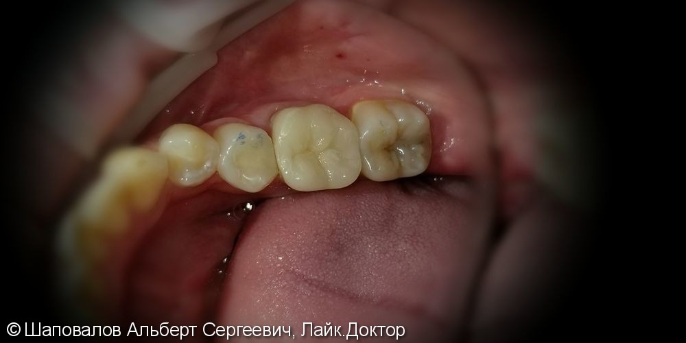 Восстановление разрушенного 3.6 зуба керамической накладкой - фото №5