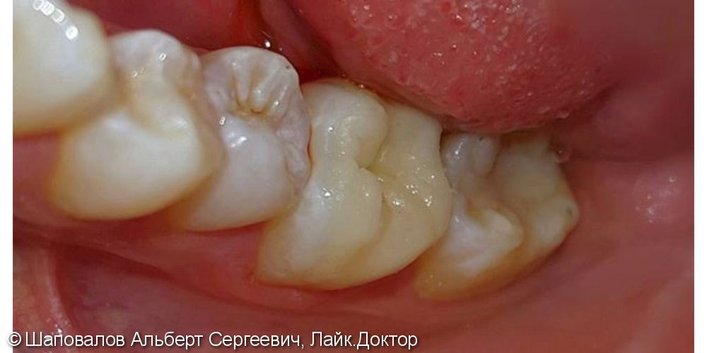 Вкладка emax, Восстановление зуба - фото №2