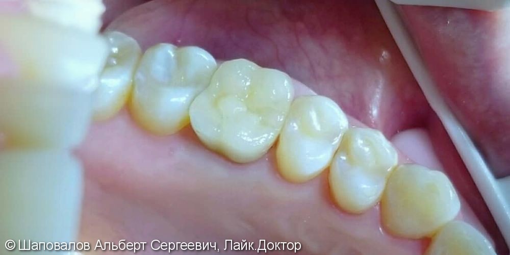 лечение кариеса 3х зубов, протезирование накладкой керамической - фото №2