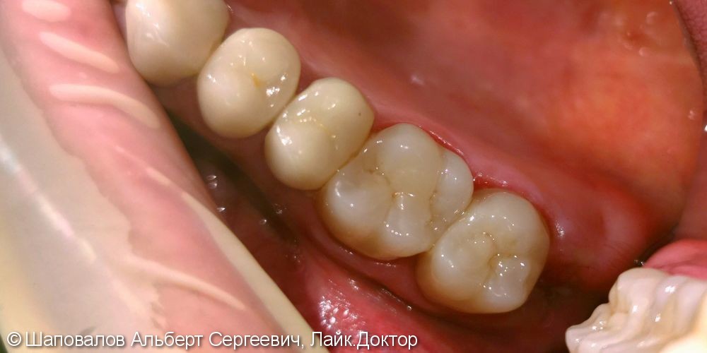 Восстановление зубов цельнокерамическими коронками - фото №2
